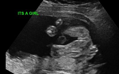 21 Week – Anatomy Scan