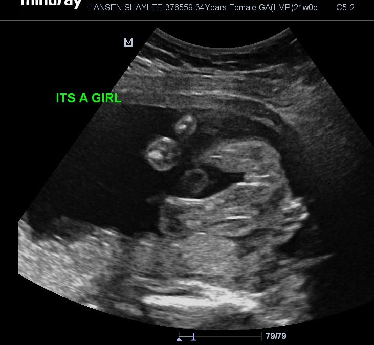 21 Week – Anatomy Scan